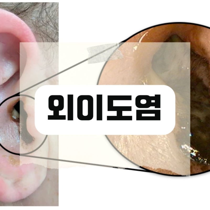 귀 외이도염 초기증상 가려움 통증 물 부음 고막