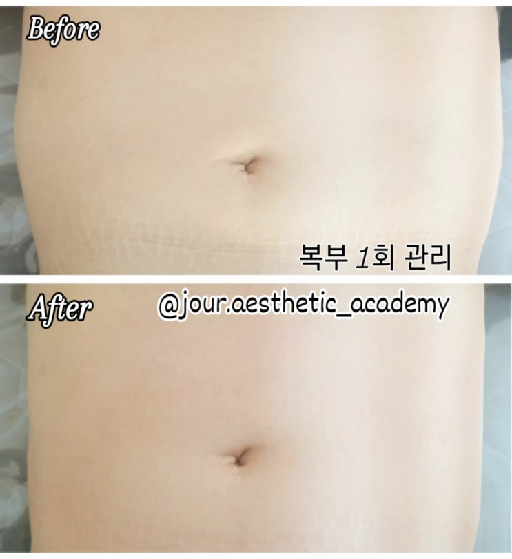  ️60분 스페셜 복부관리️부산 범일동 주르 에스테틱
