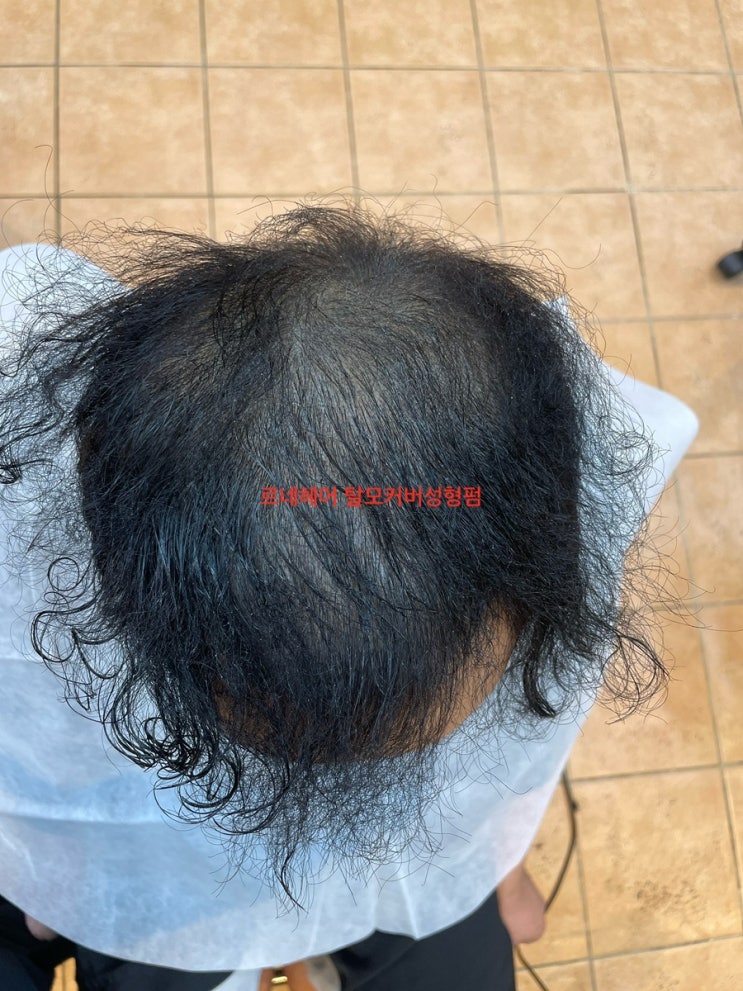  모두가항복해버린심한남자탈모 부산사상르네시떼미용실에서응급소생하다/ 탈모대머리지성탈모건성탈모원형탈모여성탈모부분탈모정수리탈모엠자탈모스트레스성탈모가발흉터이제그만