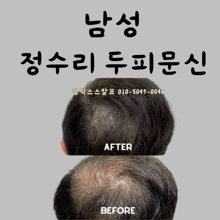  남성정수리탈모, 장기동두피문신후기