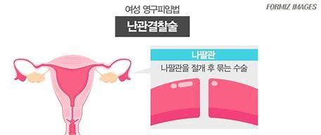 영구 피임