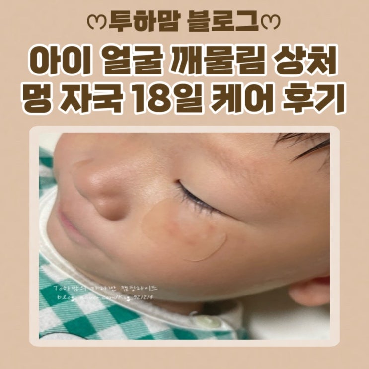  아이 얼굴 상처 어린이집에서 멍 자국 깨물림 18일 케어 후기 (프로 캄 레드엑스 미백크림, 자외선 차단 이지덤씬)