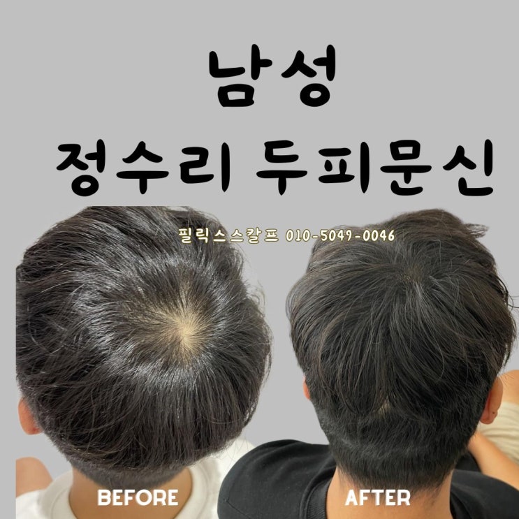  김포정수리두피문신 전문, 필릭스스칼프에서 자신감을 되찾으세요!