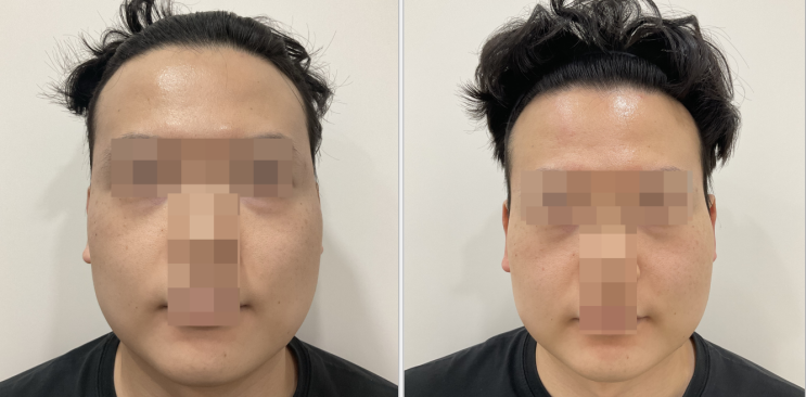  프리미 클리닉, 땅콩형 얼굴의 관자 필러 시술 전/후