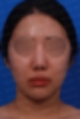 인위적인 코에서 자연스러운 아름다움으로 - 맞춤형 코 재건술 사례 [노즈랩의원]