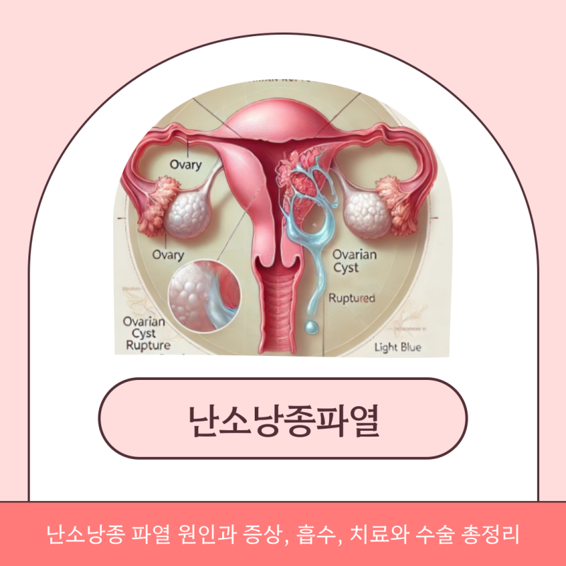 난소낭종 파열 원인과 증상, 흡수, 치료와 수술 총정리