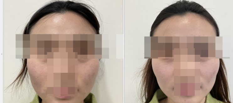  땅콩형 얼굴, 볼 패임 필러 시술 전/후