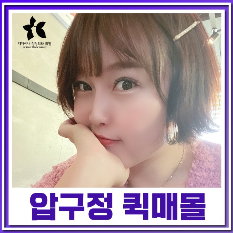  퀵매몰 압구정 쌍수 가격 및 수술 후기 확인