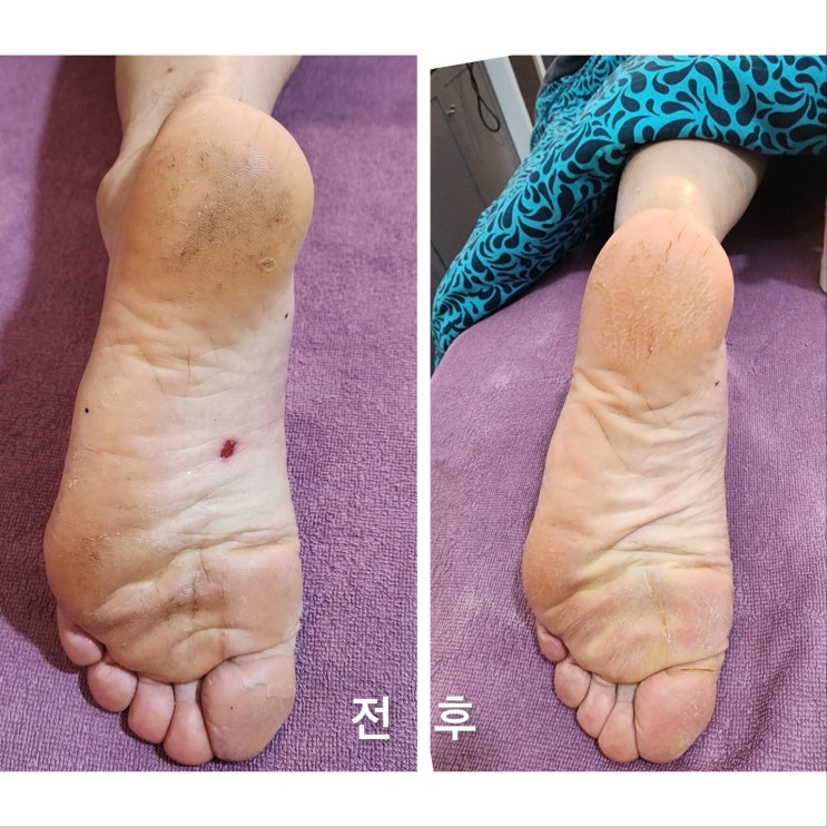  경주발관리 우리몸 축소판 발 부종 관리 가빈뷰티플러스 경주점