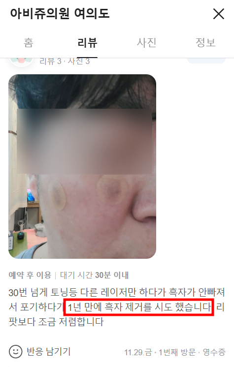 여의도피부과 50대 남자 색소질환치료 흑자제거 후기