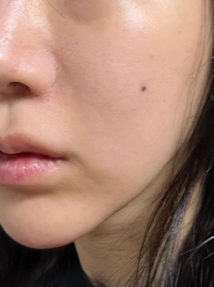  꼼꼼하게 관리받은 강남 안면홍조레이저 치료후기 (가격, 통증, 붉은기) 청담 시너지레이저
