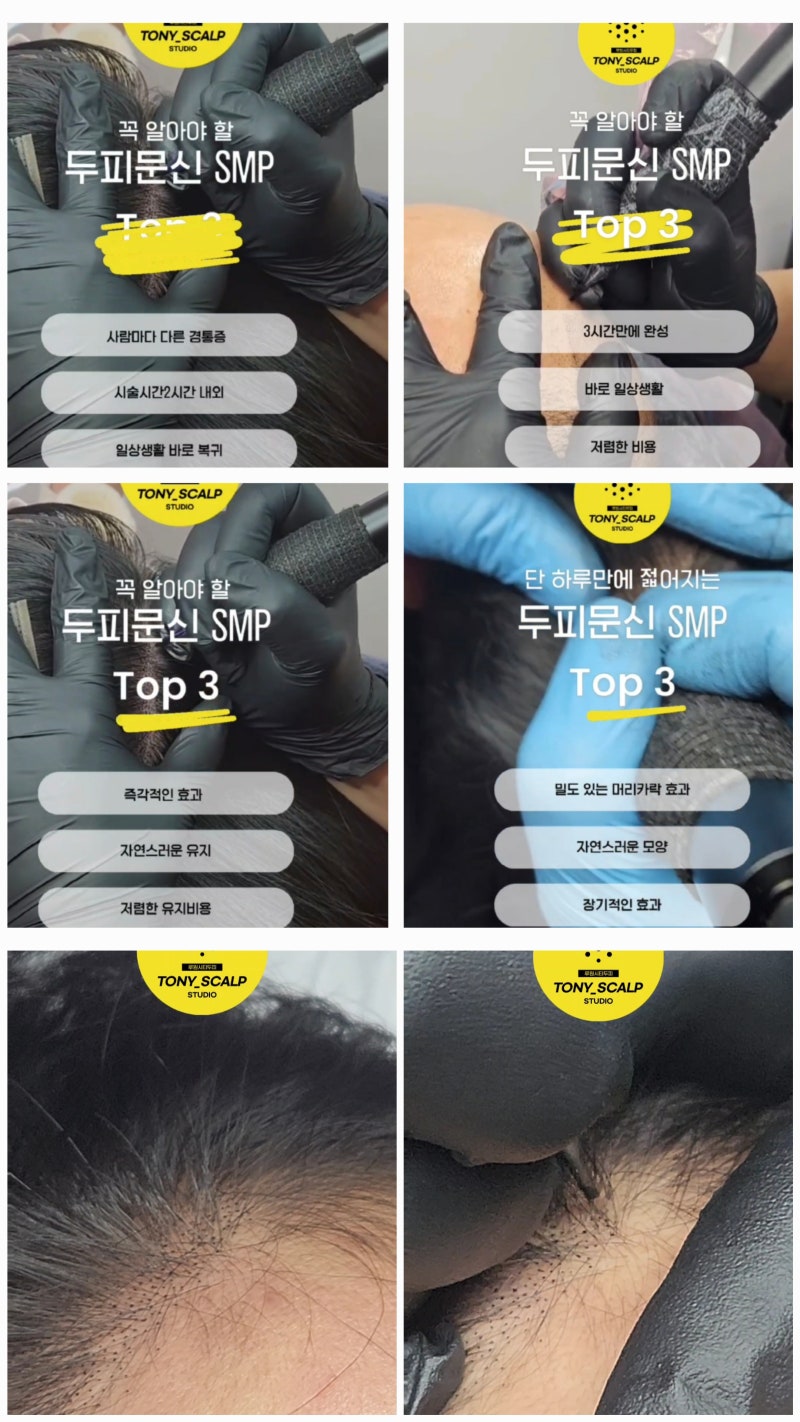 루원시티 두피와 탈모 관리 방법 제시합니다. : 네이버 블로그, image size:800x1422