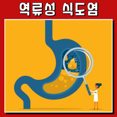 역류성 식도염 초기 증상부터 관리 비법까지 한눈에!
