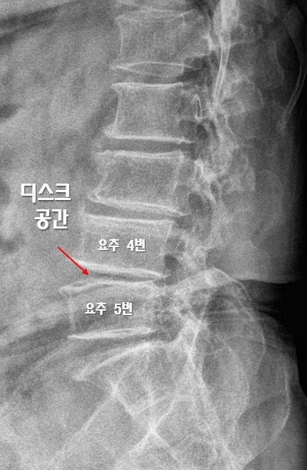  허리 엉덩이 통증? 주사치료 16번 했는데도 지속돼요!