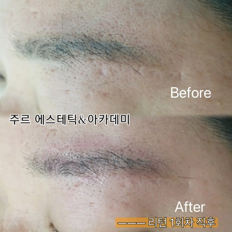  ️통증 반영구 눈썹 제거️부산 범일동 주르 에스테틱