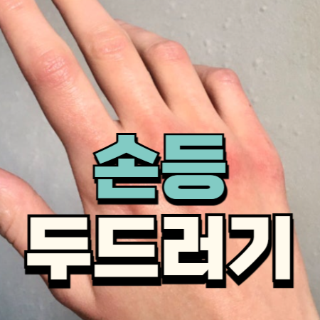 손등 좁쌀 두드러기 수포 가려움 증상 확인하기