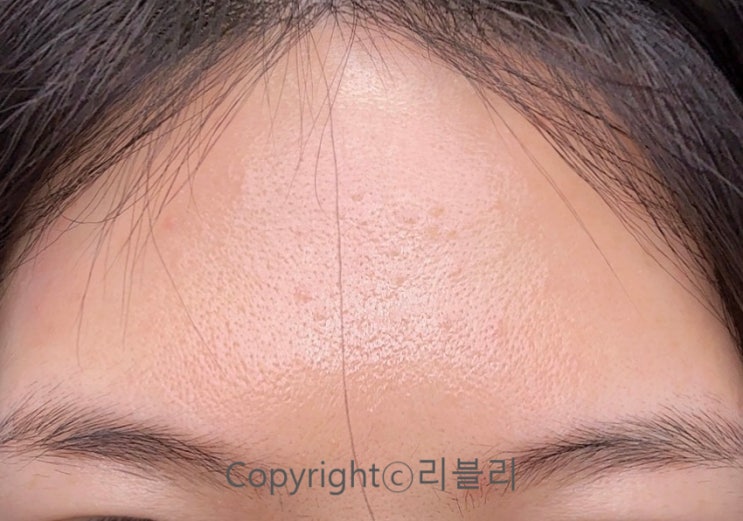 피부과 청소년여드름로션 세보케어 추천 및 여드름 원인 피부과 청소년여드름로션 세보케어 추천 및 여드름 원인