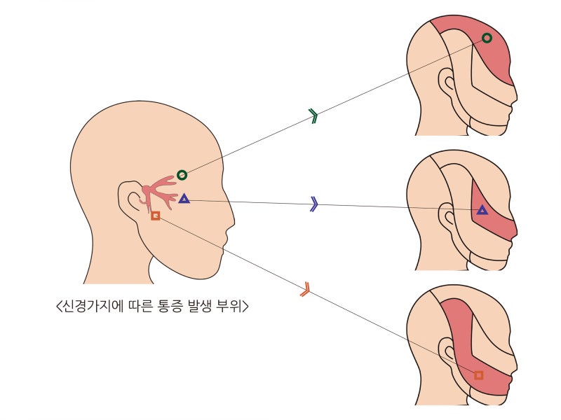 3차 신경통 병원 및 수술 치료 방법 증상(구강 안면통증 얼굴통증 원인)