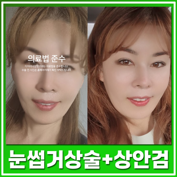  눈썹거상술 후기 눈꺼풀 처짐이 있을 때 중년 눈수술과 함께 확인