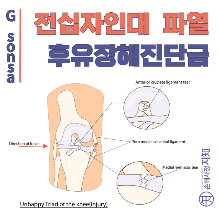  무릎 전방십자인대 파열 후유장해, 불행의 삼주징으로 발생했다면 이렇게 받으세요! - [아빠의 질병, 2부]