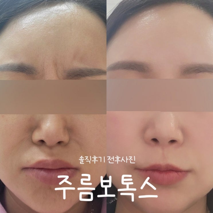  부산 덕천 피부과 이마 미간 주름 보톡스 내돈내산 솔직후기 전후사진