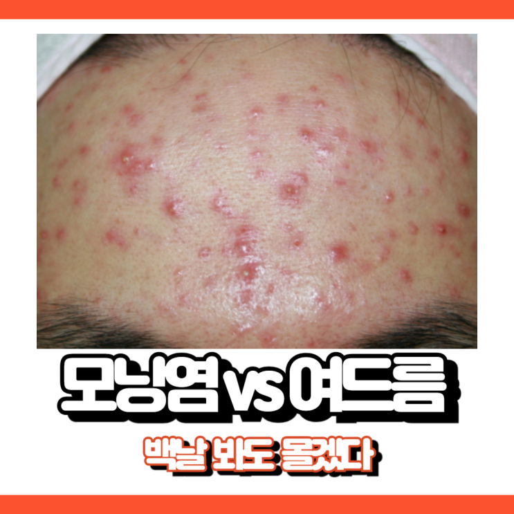  모낭염 여드름 차이 5가지 비교해봐