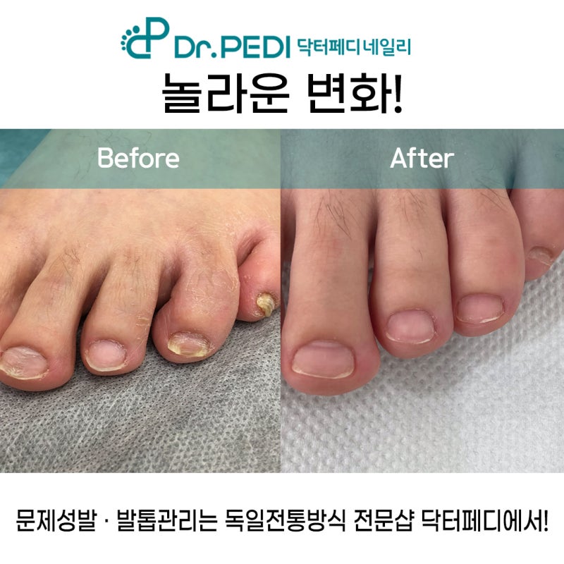 마산 발톱무좀 관리 위생 철저한 곳에서 맞춤 관리 받으세요