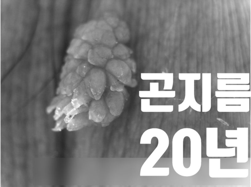 남자 곤지름 사진 보시면 남성 항문 증상은 이거죠