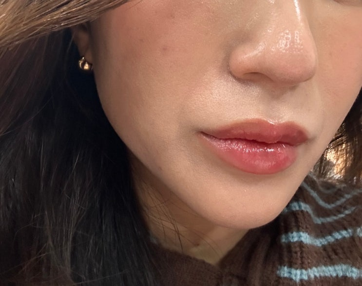  강남 신사 울쎄라 인모드 잘하는곳 가격 수면마취 통증 전후후기