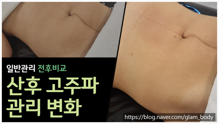  산후 부종 완화와 고주파 관리의 중요성
