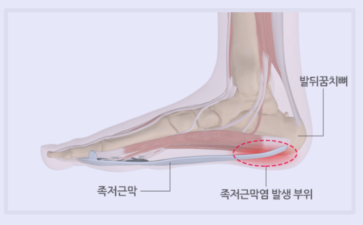  족저근막염 증상 원인 통증 스트레칭 치료