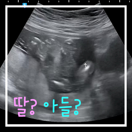  우리 첫 조카 아들 ? 딸 ? 아기 성별 맞추기 - 17주 아기성별