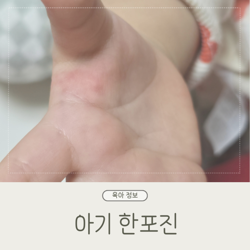 아기 손가락 한포진 원인 관리 방법 경험담