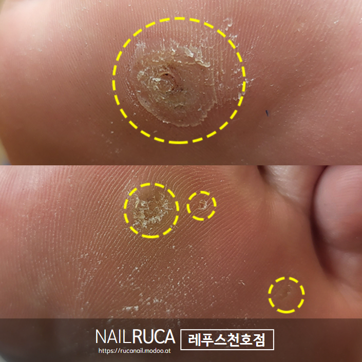 레푸스 티눈 제거 후기 및 비용 안내