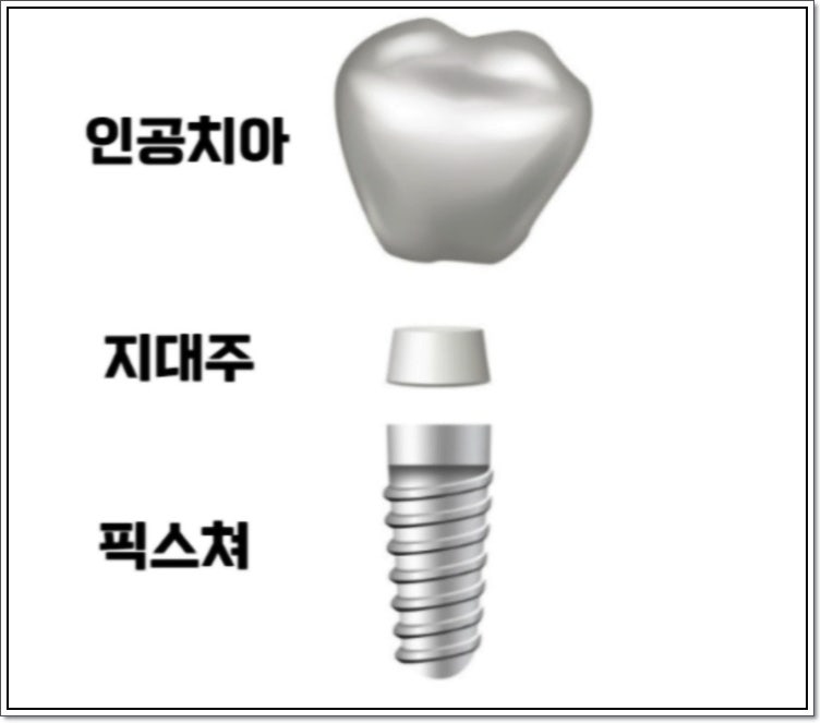 안산임플란트