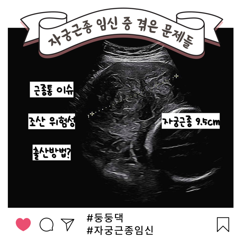 자궁근종 9cm 임신 중 겪은 문제들 근종통 출산방법
