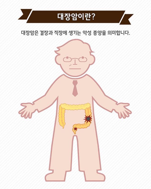  대장암 총정리