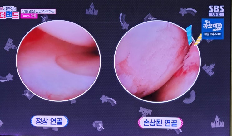  무릎활액막염 물이 차는 원인 증상 예방 치료 방법을 알아봐요