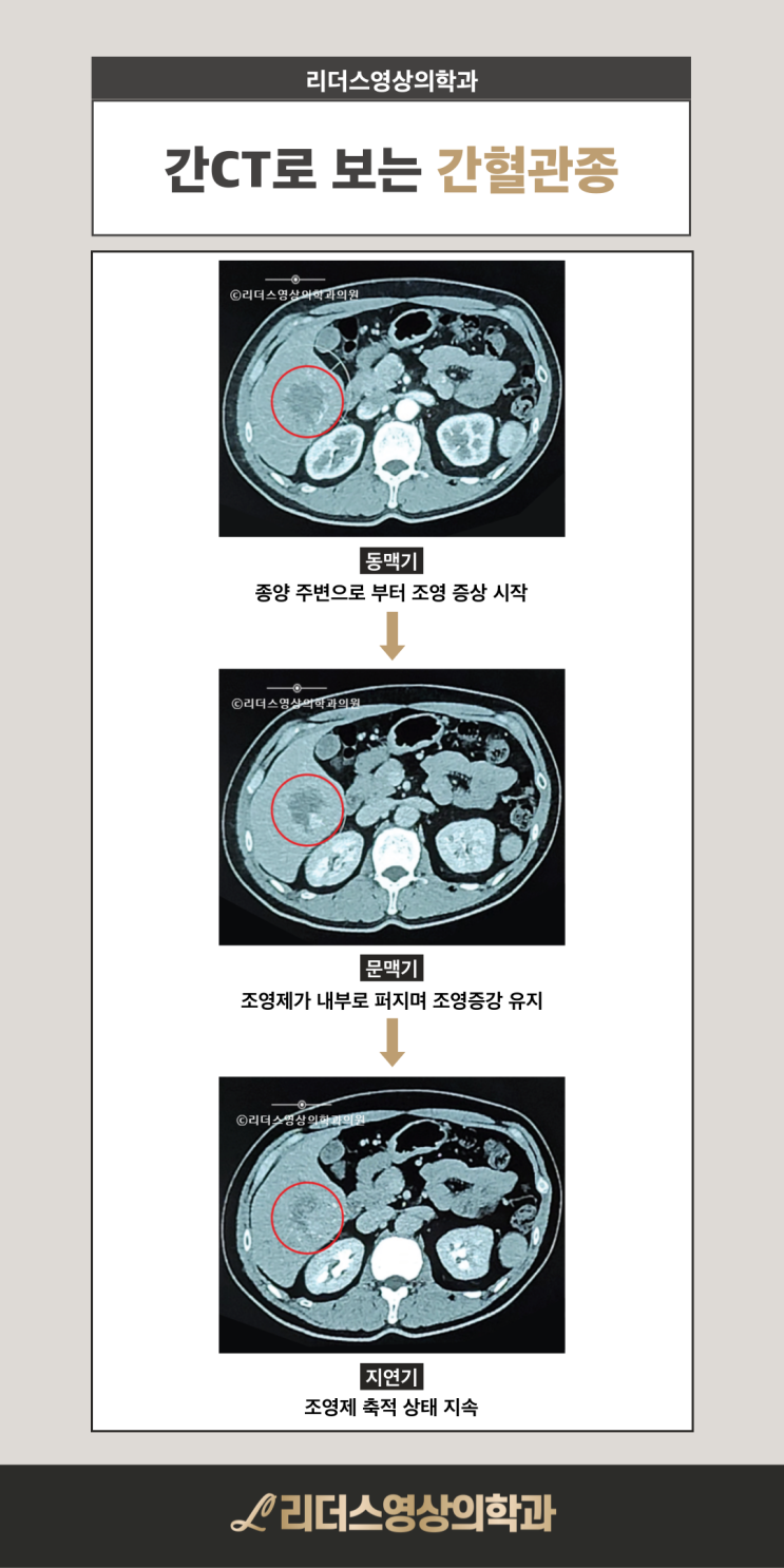  인천 건강검진 간혈관종이란? CT로 보는 간암과 차이점