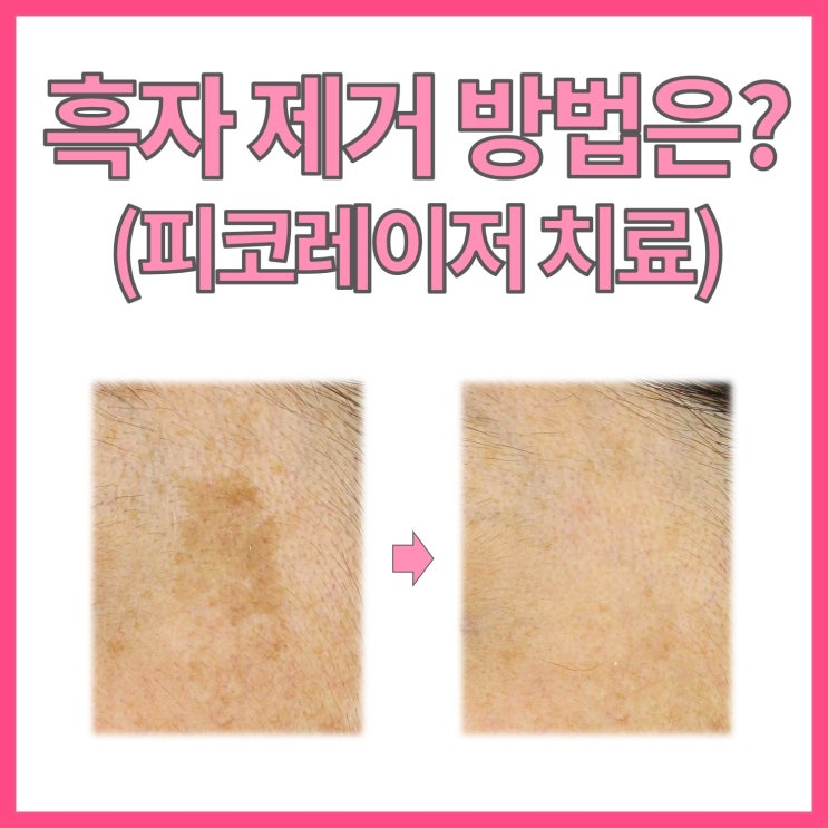  얼굴에 생기는 커다란 점? 흑자에 관하여