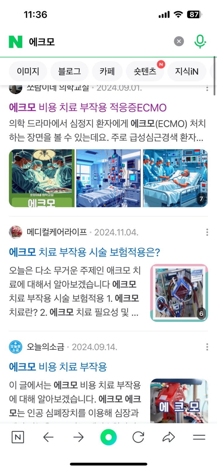 [급성골수성<b>백혈병</b>-폐숙주] 숙주반응 기도 좁아짐으로 결국... 
