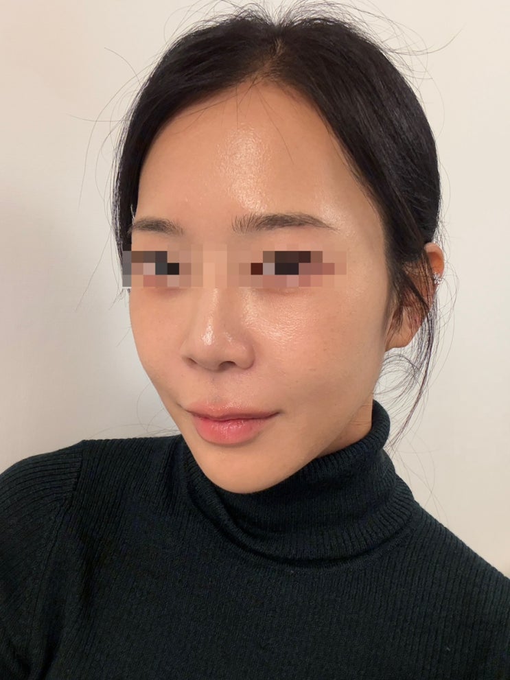  신사역 성형외과 스킨부스터 리제반효과 찐후기 리제반리쥬란 비교
