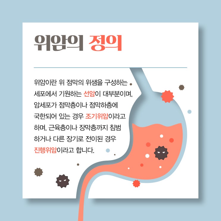 위암에 대해 자세하게 알아보기