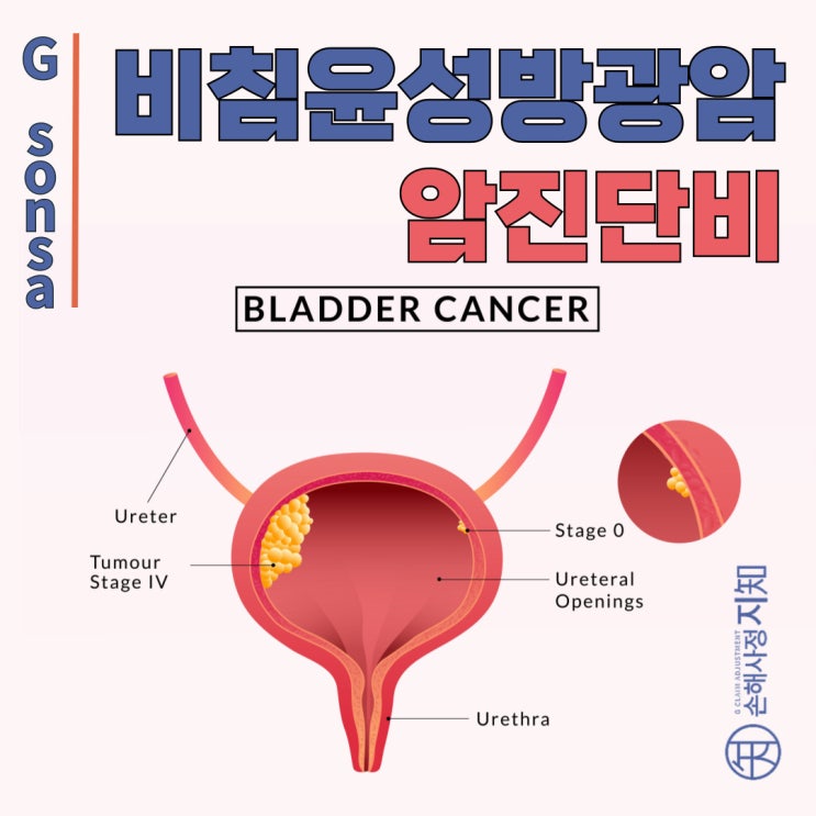  비침윤성 방광암, 보험금 청구의 모든 것! 놓치지 말아야 할 핵심 포인트 - 〔아빠의 질병〕