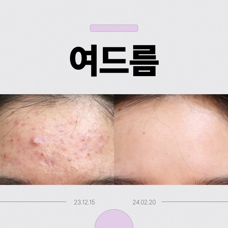  응암역피부과 겨울방학 여드름관리 신중해야되는 까닭? (실비 화장품)