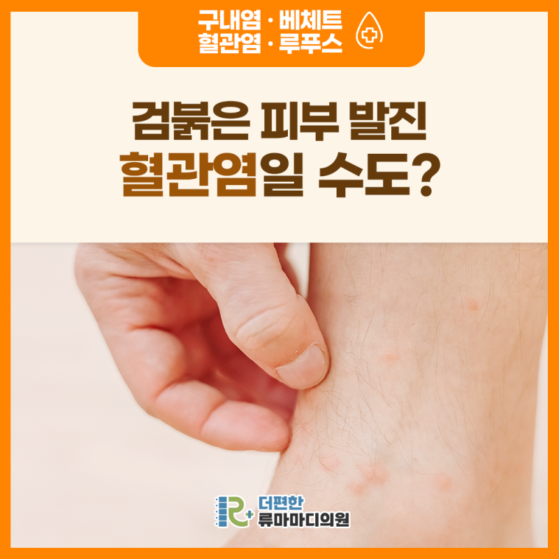 검붉은 피부 발진, 혈관염 일 수 도 있습니다! ｜류마티스 전문의 치료가 필요한 이유