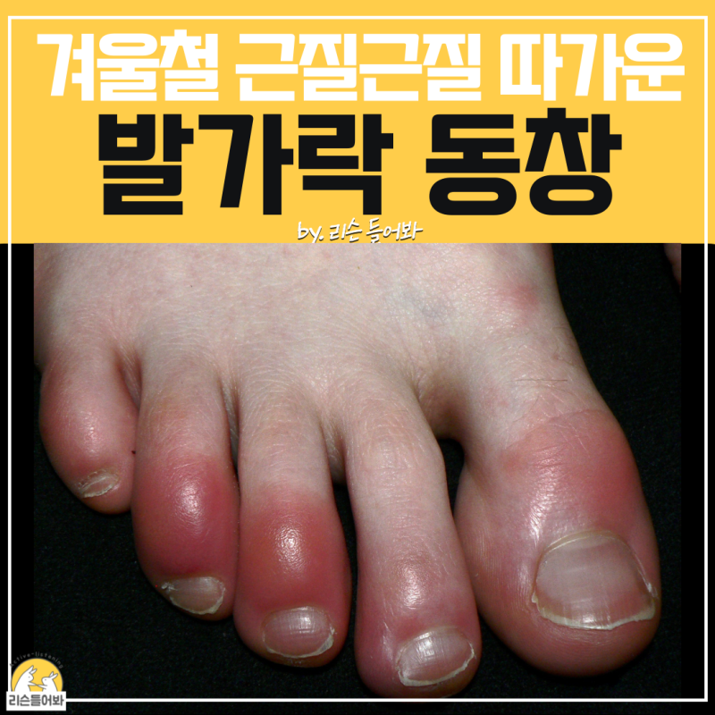 발가락 가려움 증상 원인이 동창? 동상과 뭐가 달라?