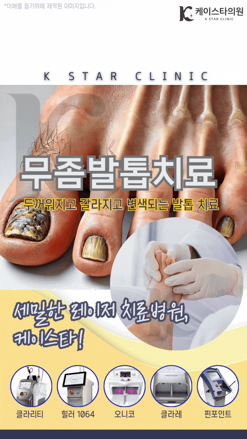 광주무좀치료 발톱멍으로 오해하기 쉬운 무좀엔 레이저 치료를