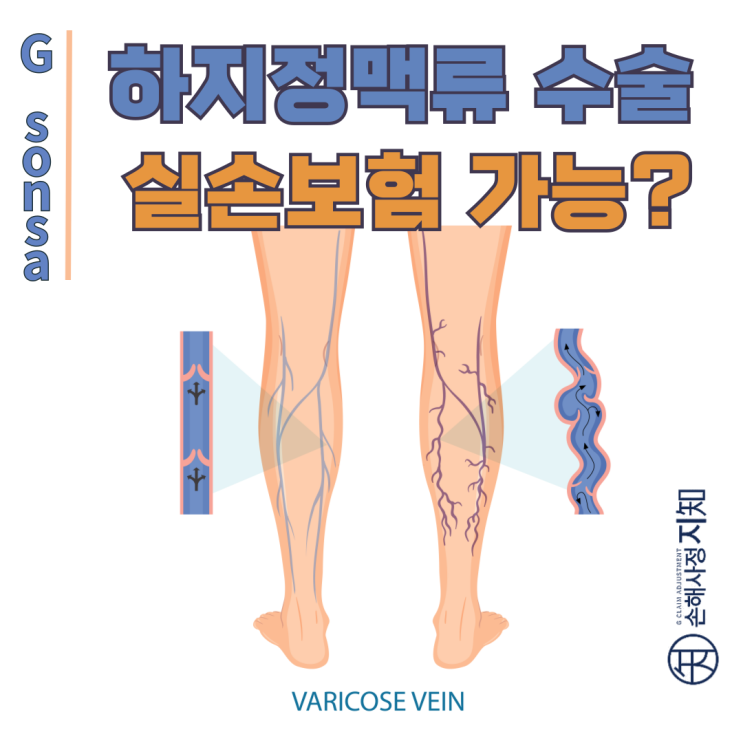  하지정맥류 수술, 보험금 청구의 숨겨진 비밀과 필수 체크리스트 - [보도자료, BoDa]