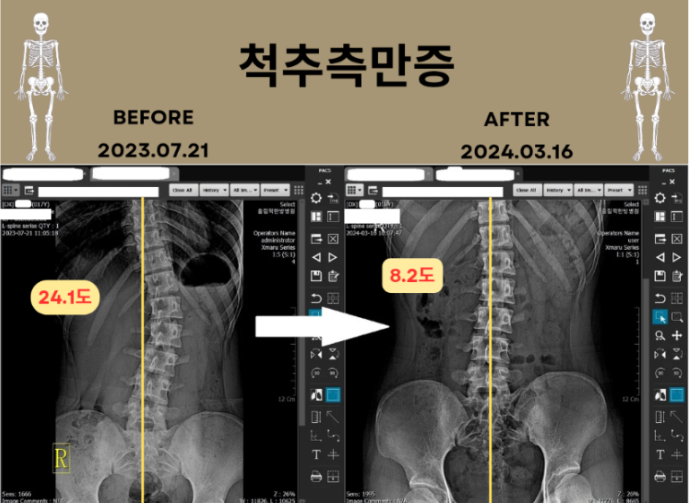 광주북구한방병원에서 8개월간의 치료 광주북구한방병원에서 8개월간의 치료